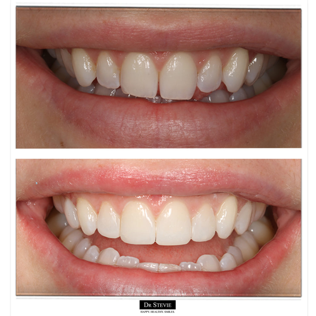 Composite Bonding