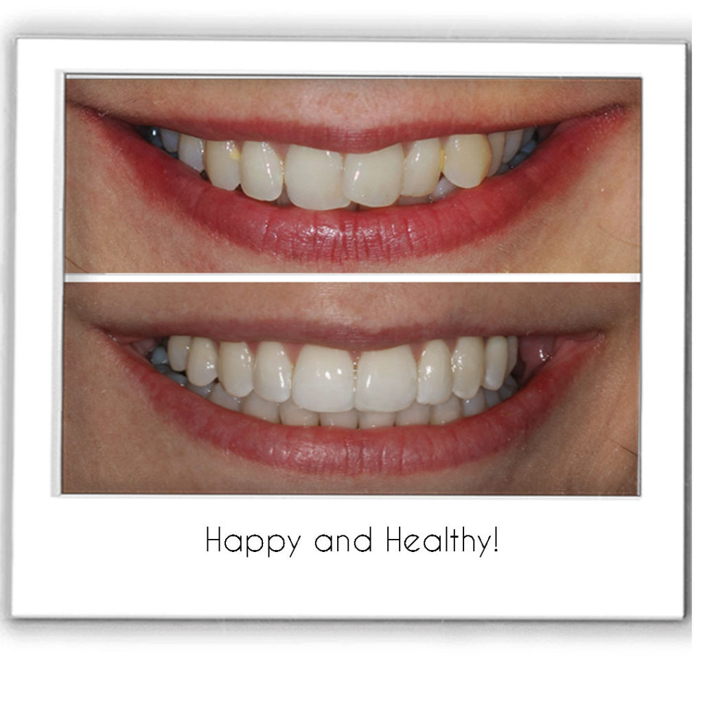 Invisalign