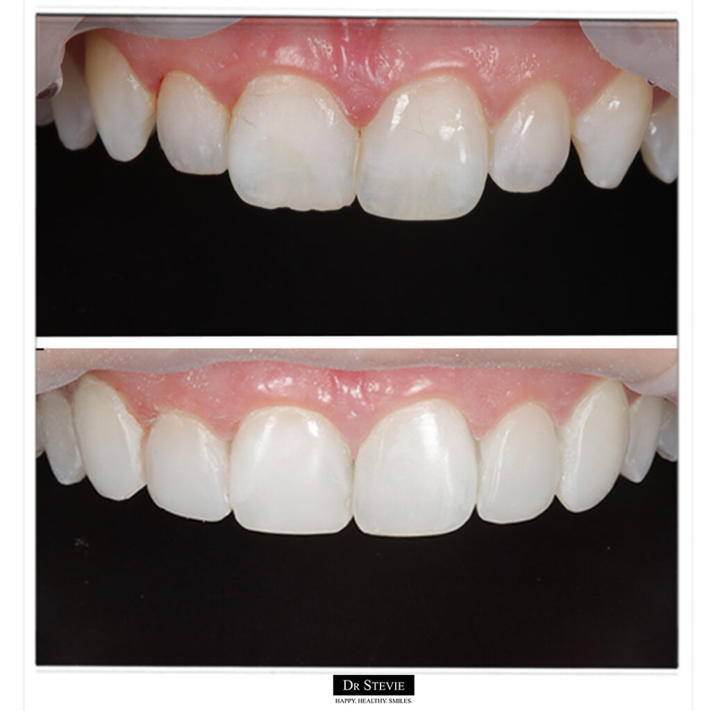 Composite Bonding