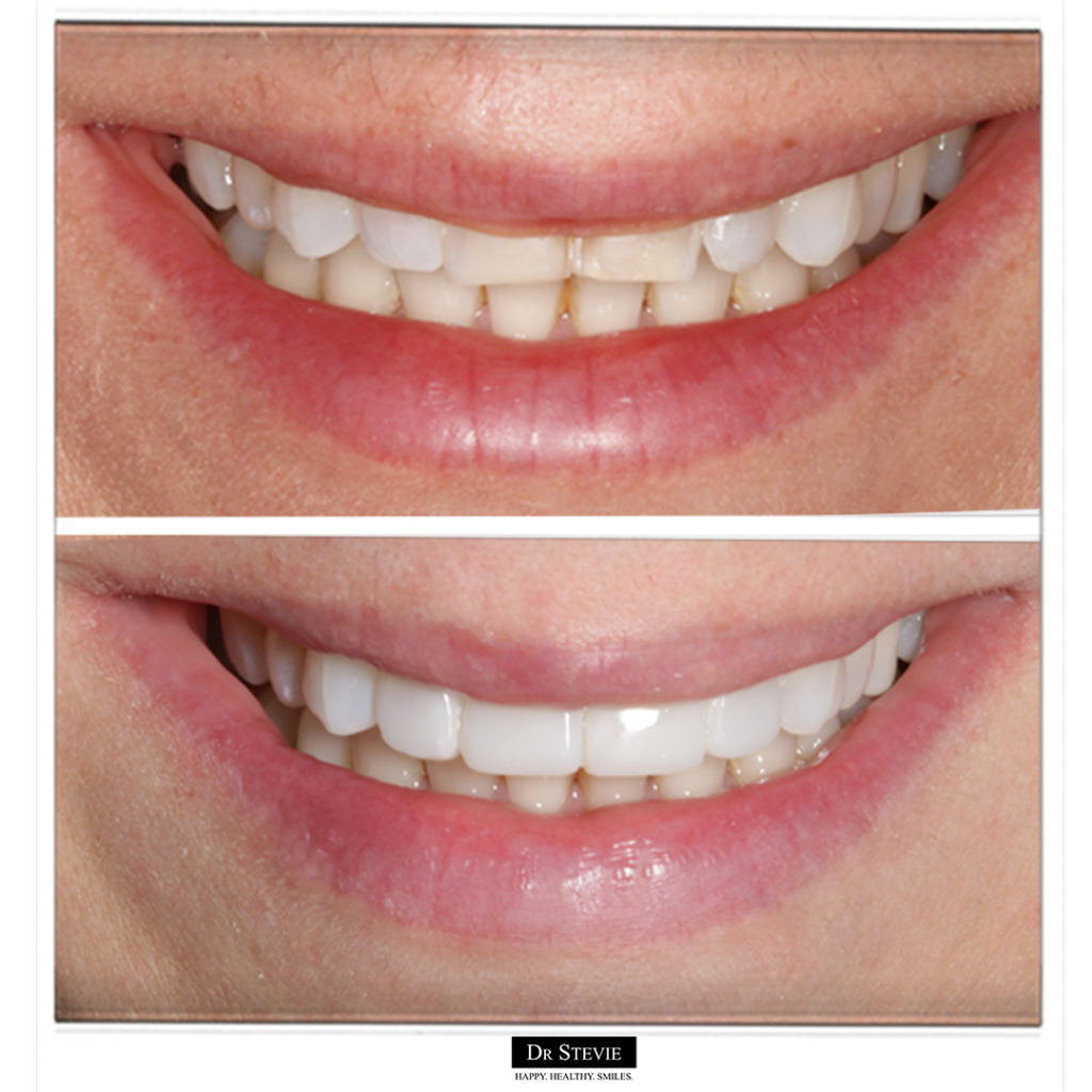 Composite Bonding