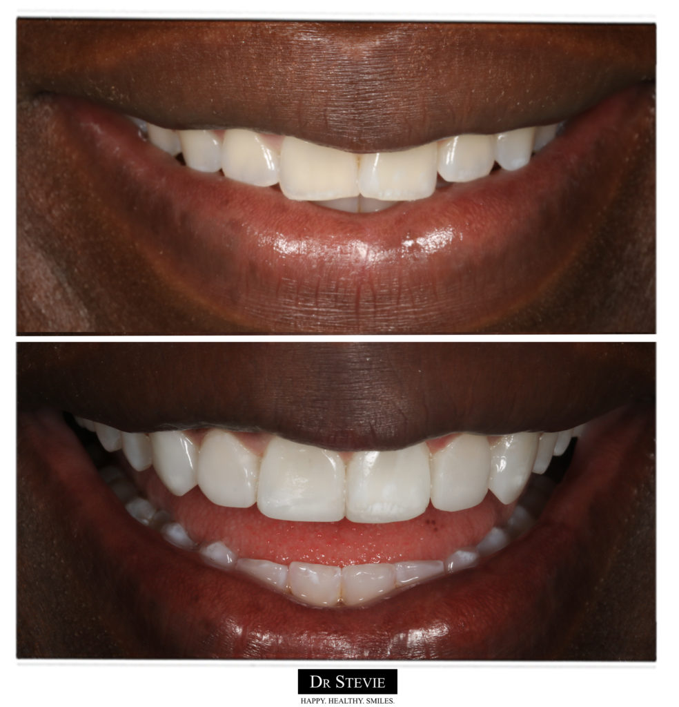Composite bonding