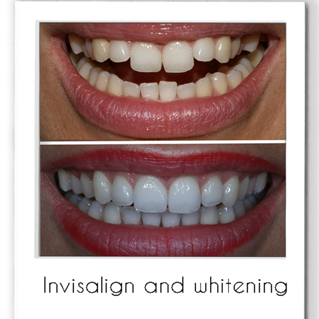 Invisalign and Whitening