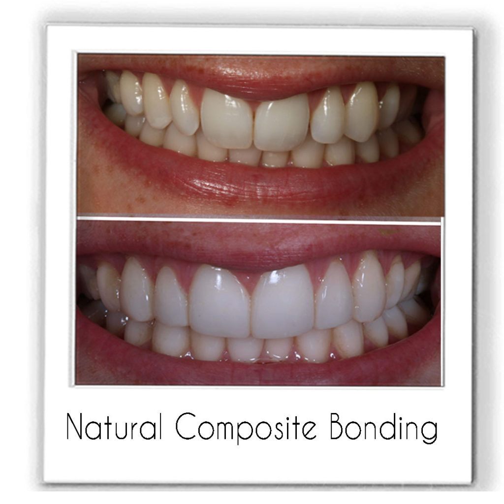 Composite Bonding
