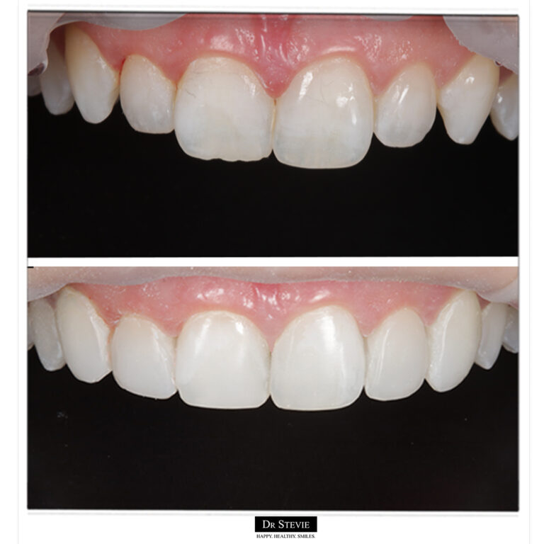 Composite Bonding