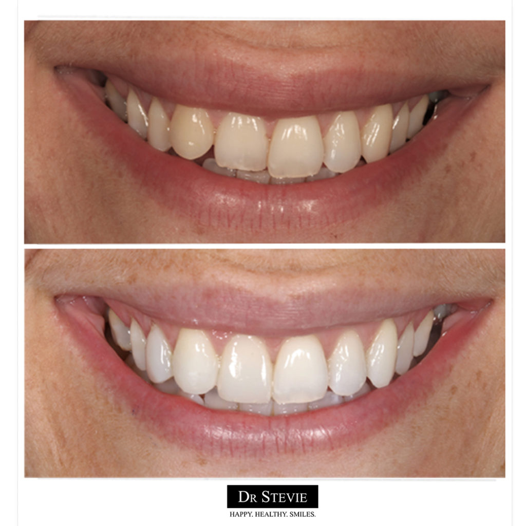 Composite bonding and Whitening