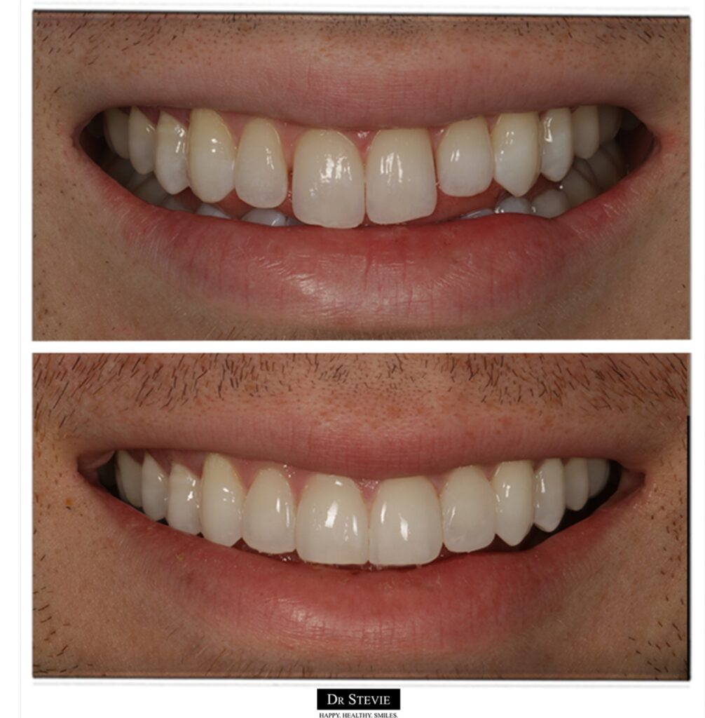 Composite bonding