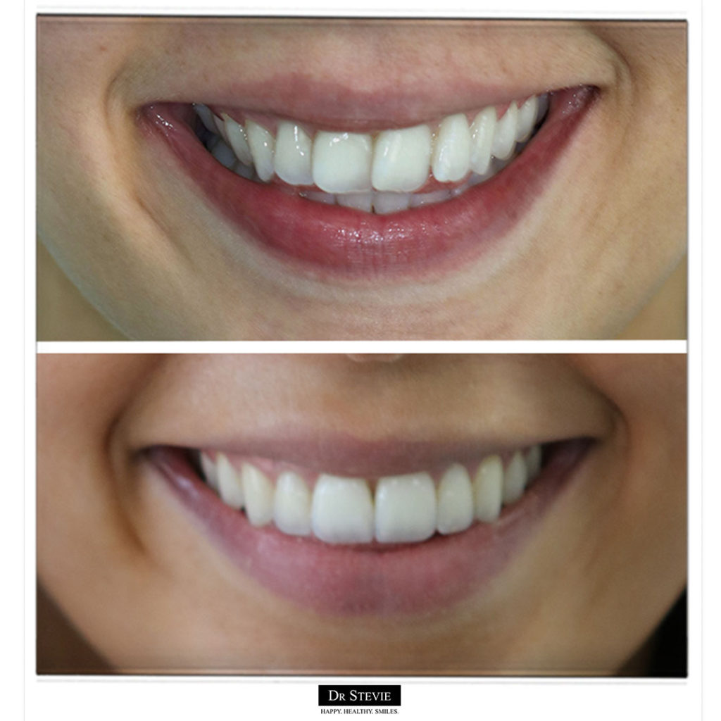 Invisalign