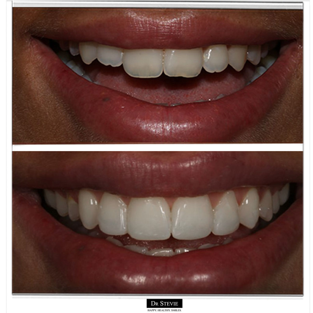 Composite Bonding