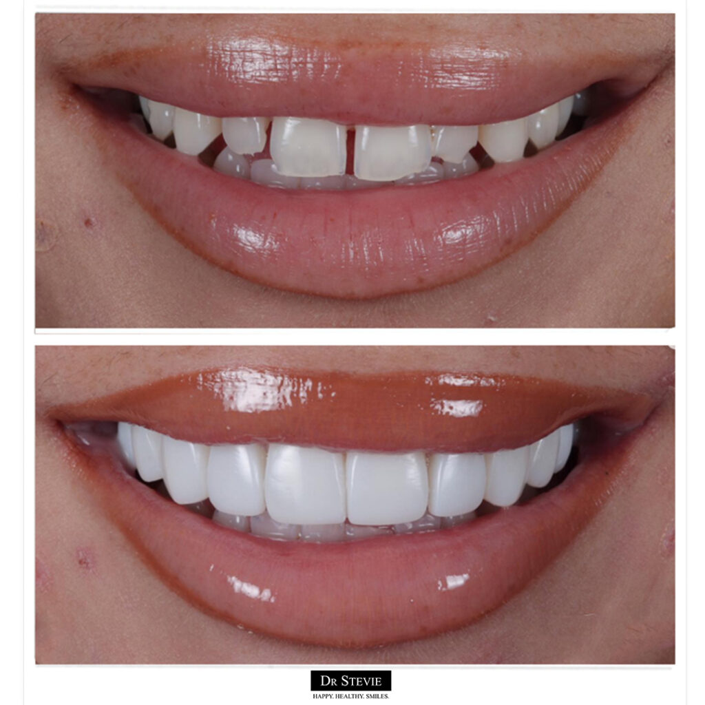 Composite bonding