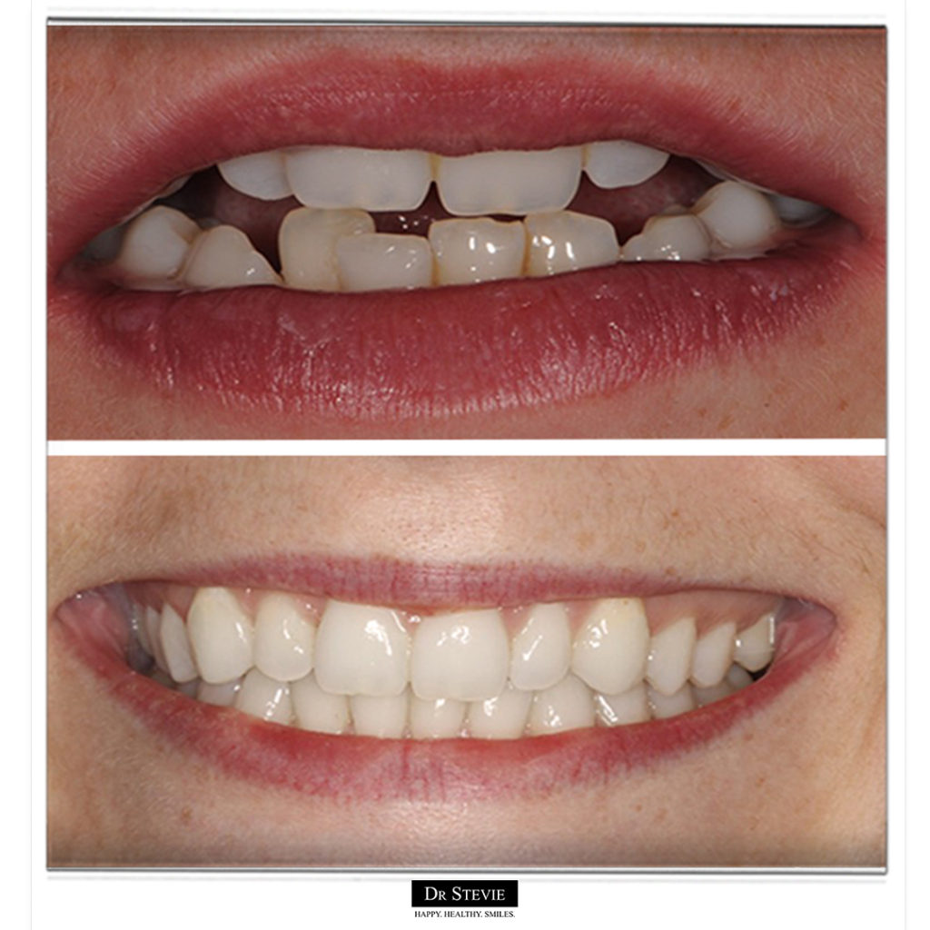 Invisalign