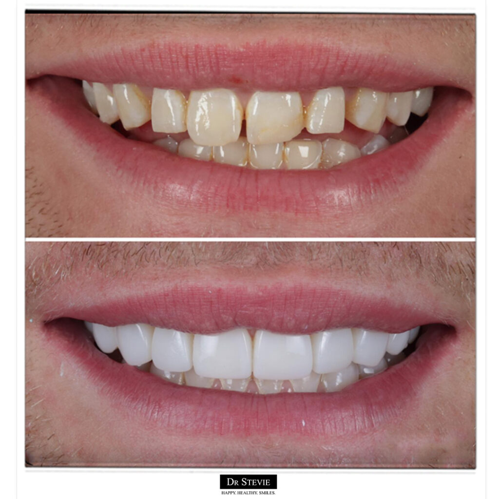Composite bonding