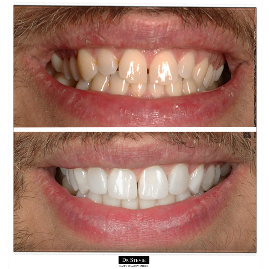 Composite Bonding