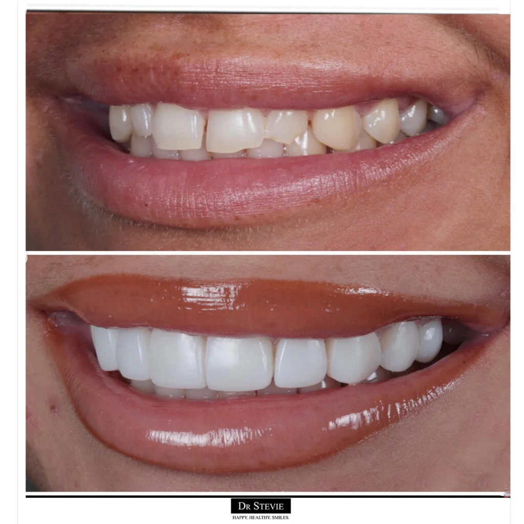 Composite bonding