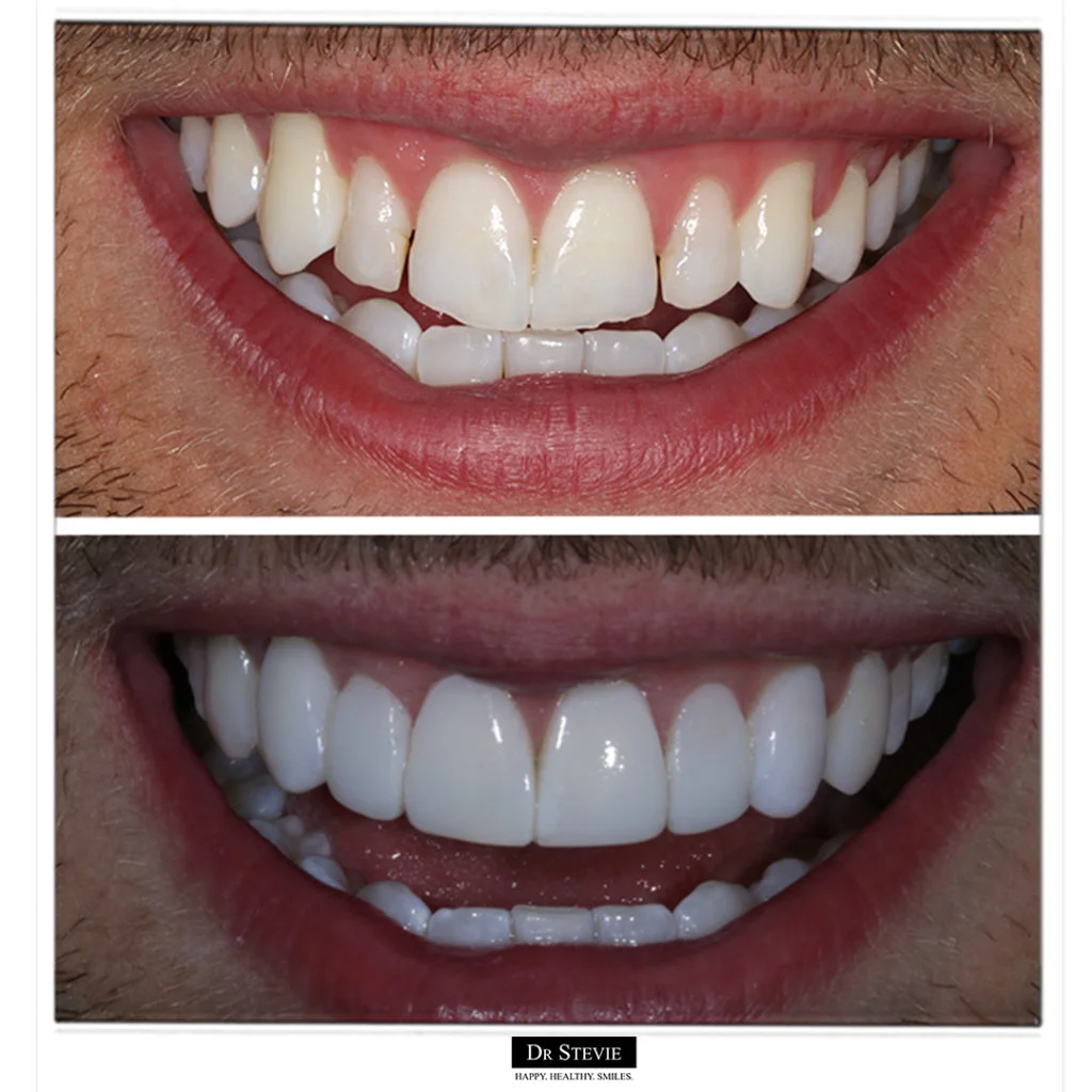 Whitening and Composite Bonding