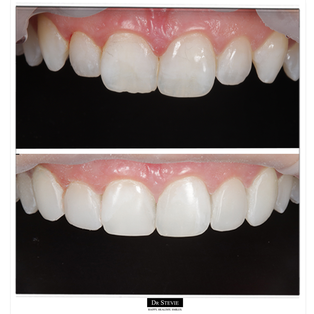 Composite Bonding: A Simple and Cost-Effective Solution for a Perfect Smile